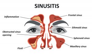 Sinusitis